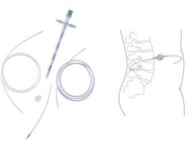 索菲萨 脑脊液分流器及其组件 