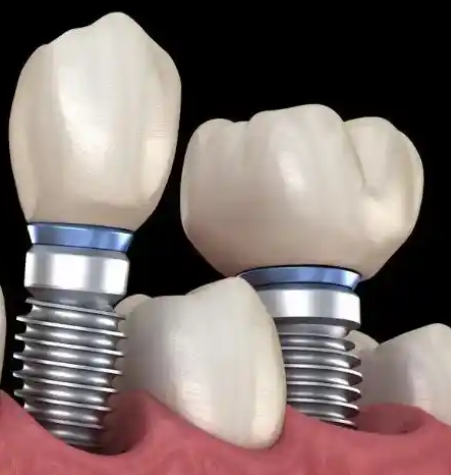 安卓健牙种植体