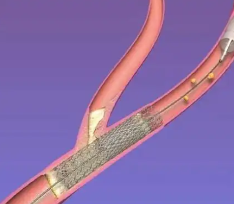颈动脉支架CPR-0520-143RX