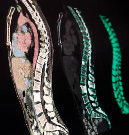 脊柱外科手术计划软件Spine Planning博医来